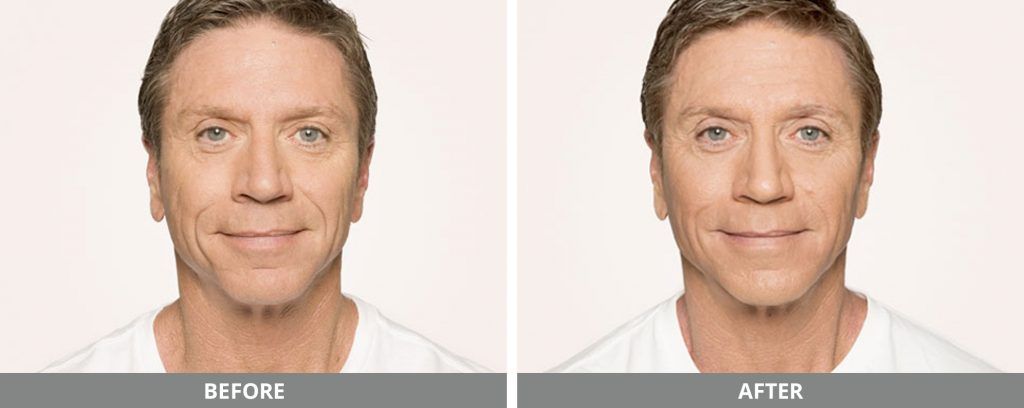 radiesse before and after 1