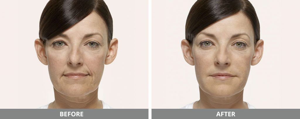 radiesse before and after 2
