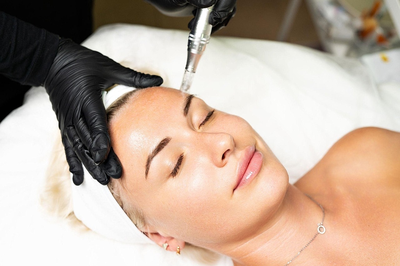 Facial treatment with microneedling technique in progress.