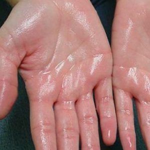 med spa patient model with hyperhidrosis