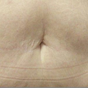 med spa patient model with excess fat
