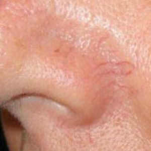 medspa patient model with nasal vessles