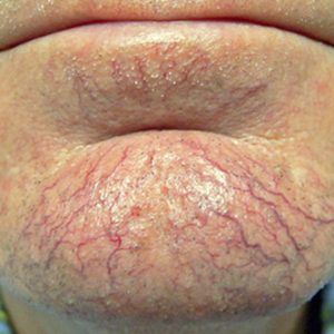 med spa patient model with broken capillaries