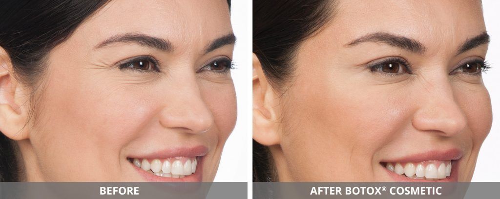 Botox Dysport Before & After