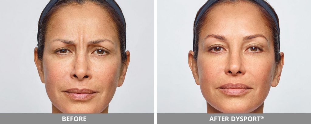 Botox Dysport Before & After