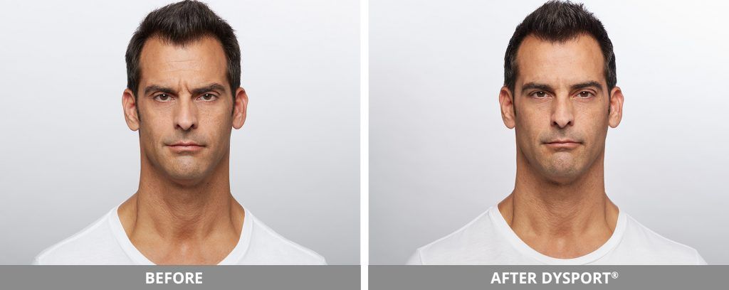 Botox Dysport Before & After