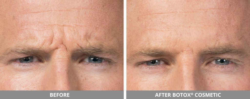 Botox Dysport Before & After