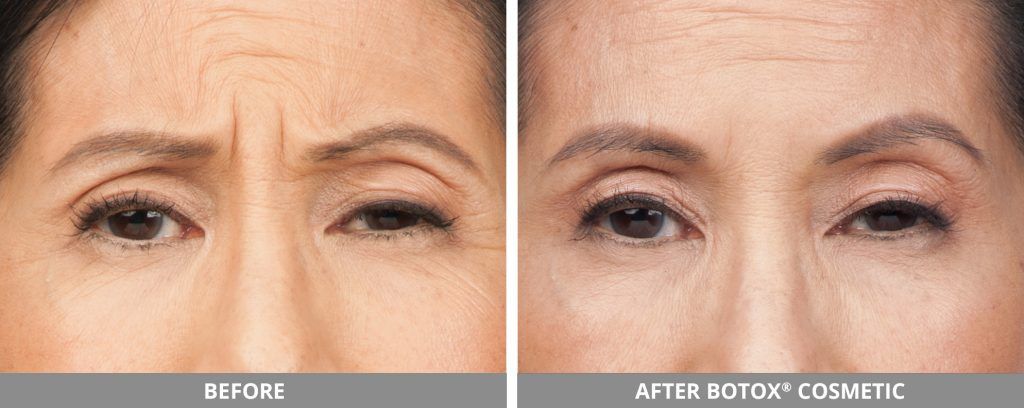 Botox Dysport Before & After