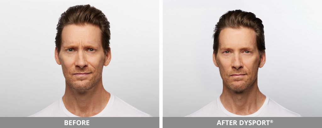 Botox Dysport Before & After