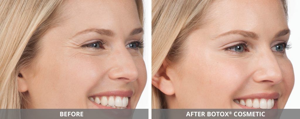 Botox Dysport Before & After