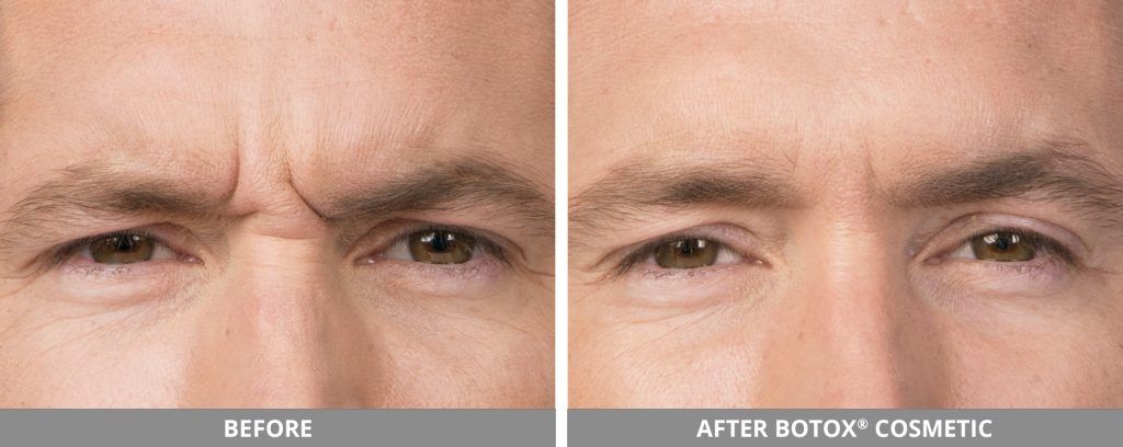 Botox Dysport Before & After