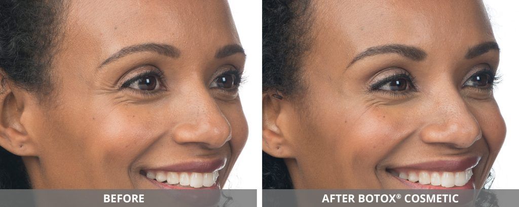 Botox Dysport Before & After