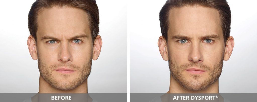 Botox Dysport Before & After