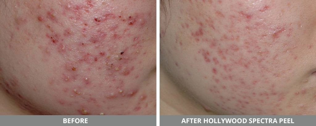 Yag Laser Before & After