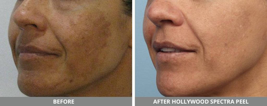 Yag Laser Before & After