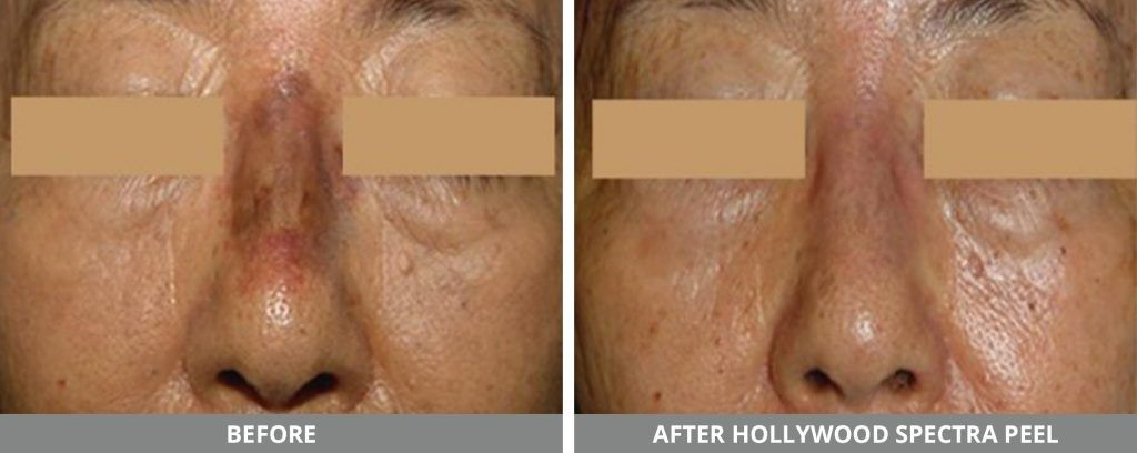 Yag Laser Before & After