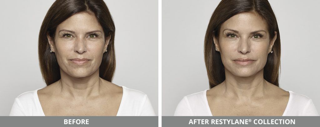 Restylane Before & After