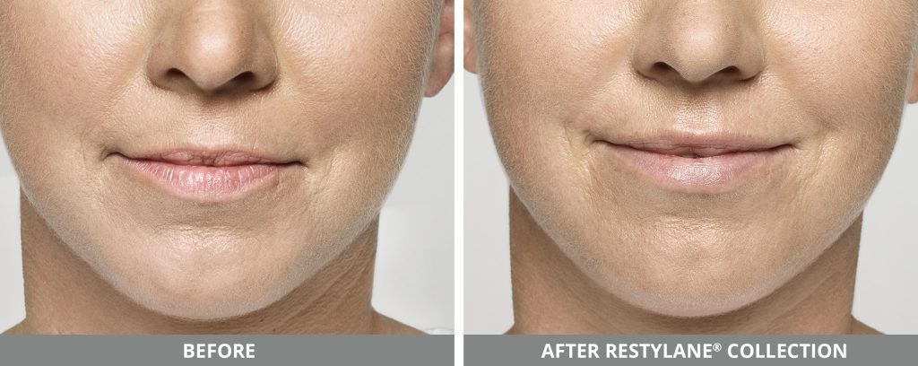 Restylane Before & After
