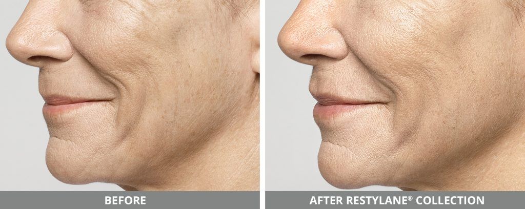 Restylane Before & After