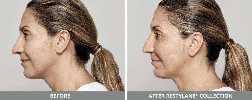 Restylane Before & After