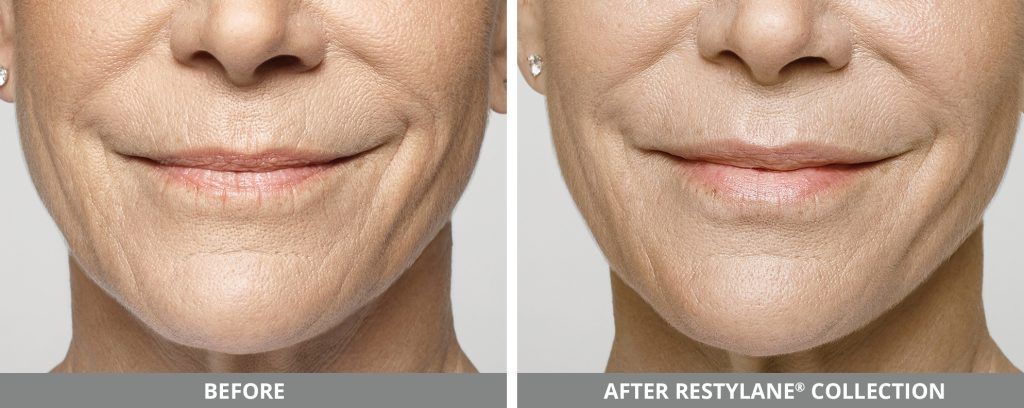 Restylane Before & After