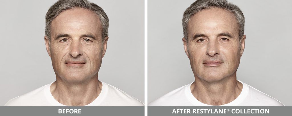 Restylane Before & After