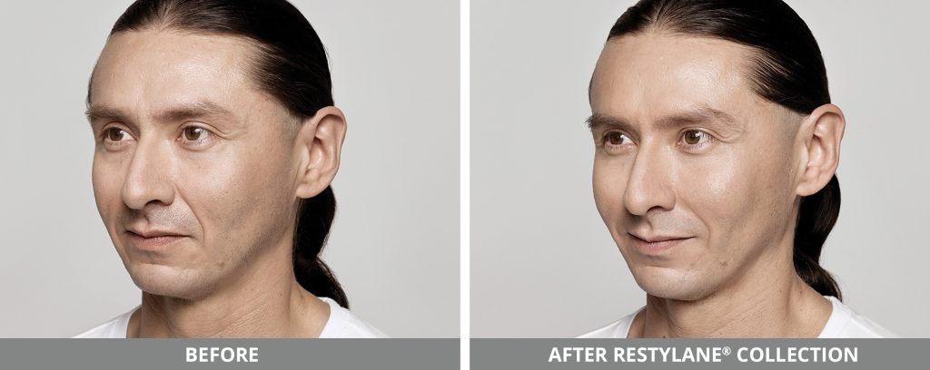 Restylane Before & After