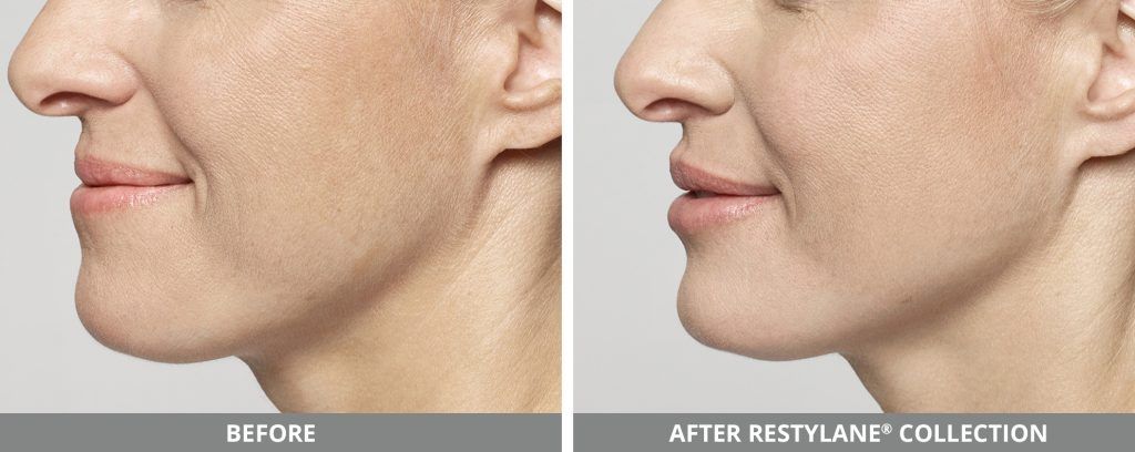 Restylane Before & After