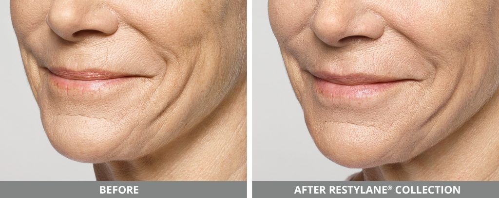 Restylane Before & After