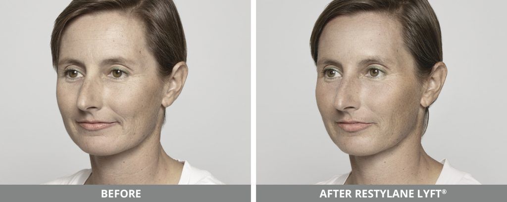Restylane Before & After
