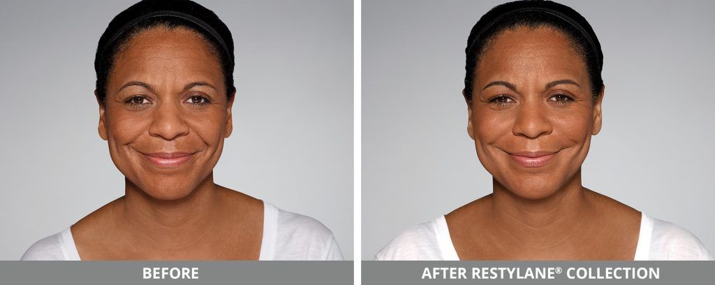 Restylane Before & After