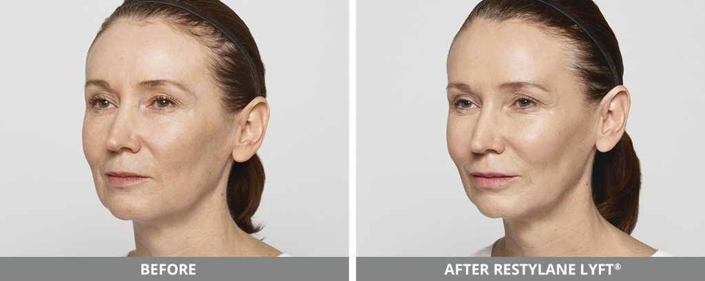 Restylane Before & After