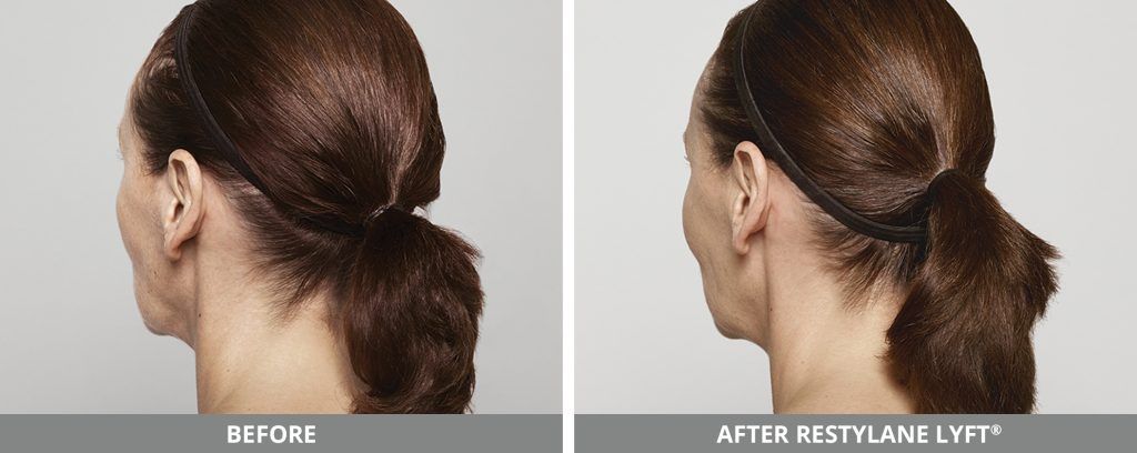 Restylane Before & After