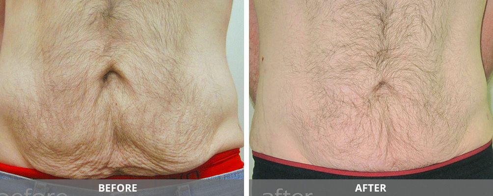 Facial And Body Contouring Before & After