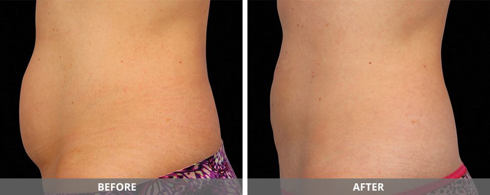 Facial And Body Contouring Before & After