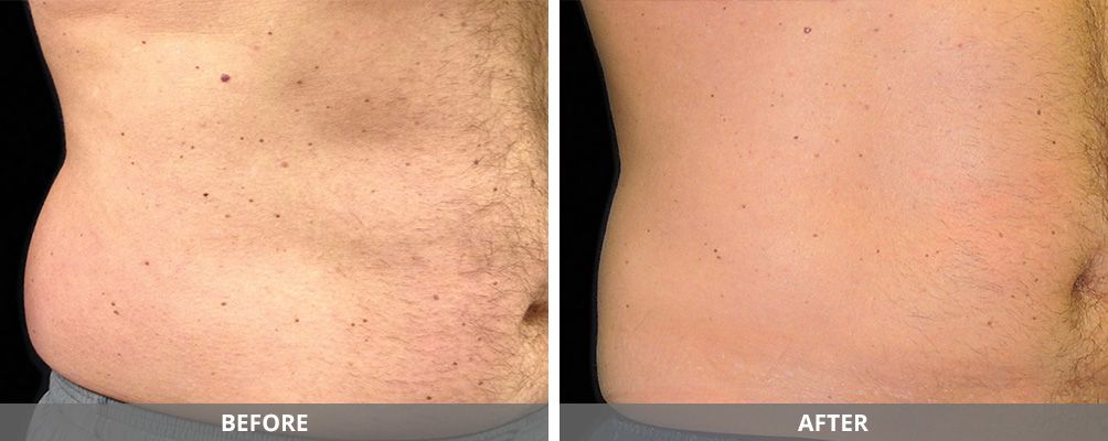 Facial And Body Contouring Before & After