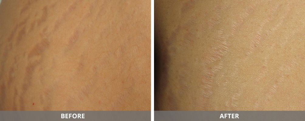 Facial And Body Contouring Before & After