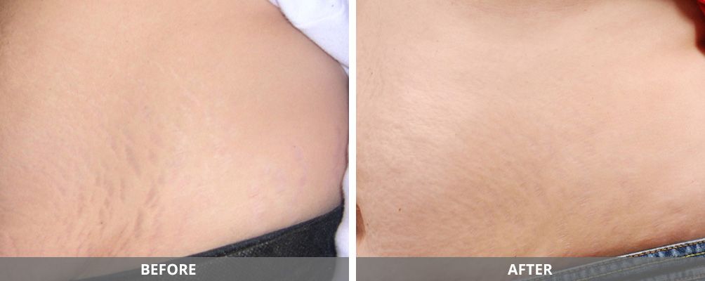 Facial And Body Contouring Before & After