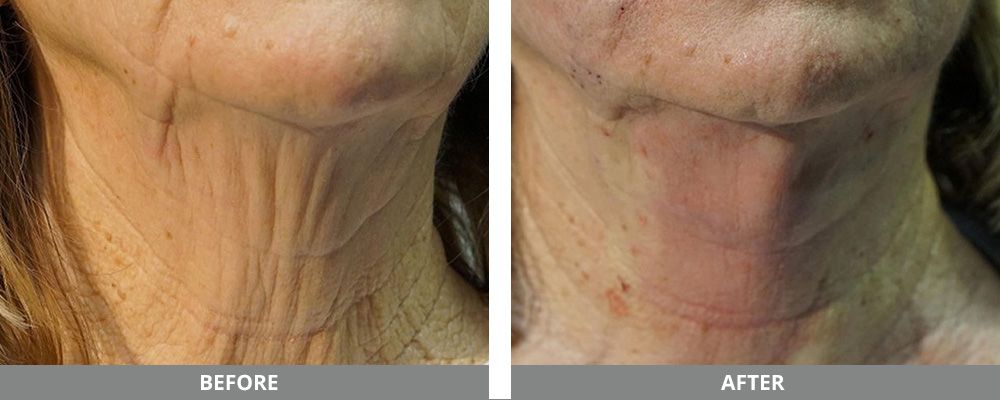 Pdo Thread Before & After