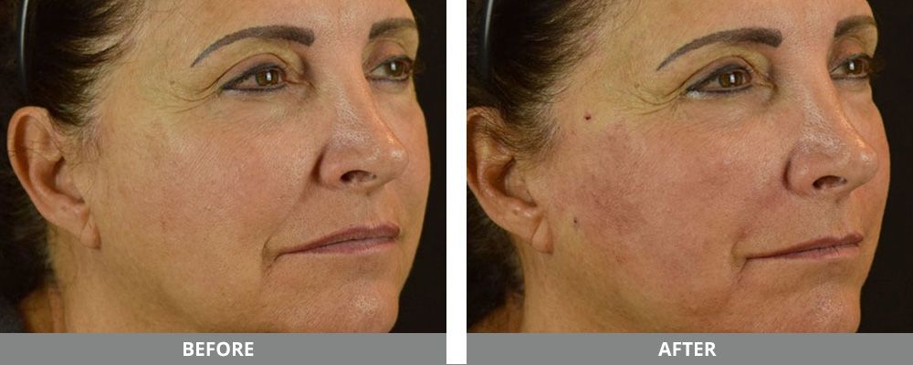 Pdo Thread Before & After