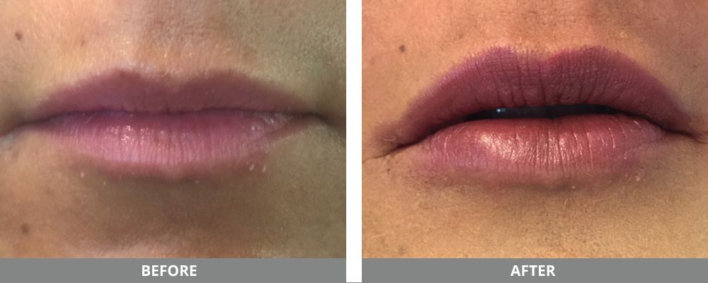 Pdo Thread Before & After