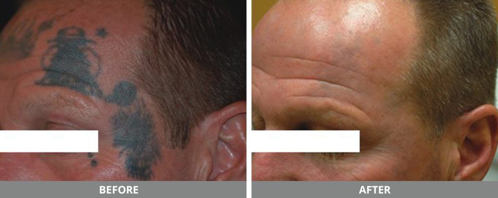 Laser Tattoo Removal Before & After