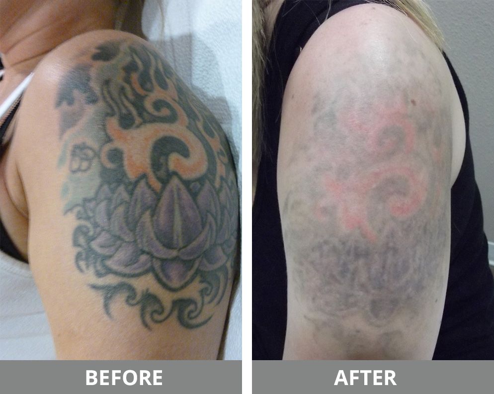 Laser Tattoo Removal Before & After
