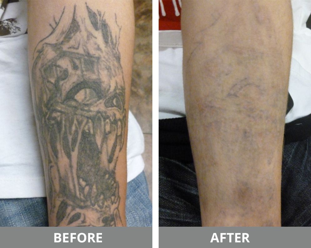 Laser Tattoo Removal Before & After