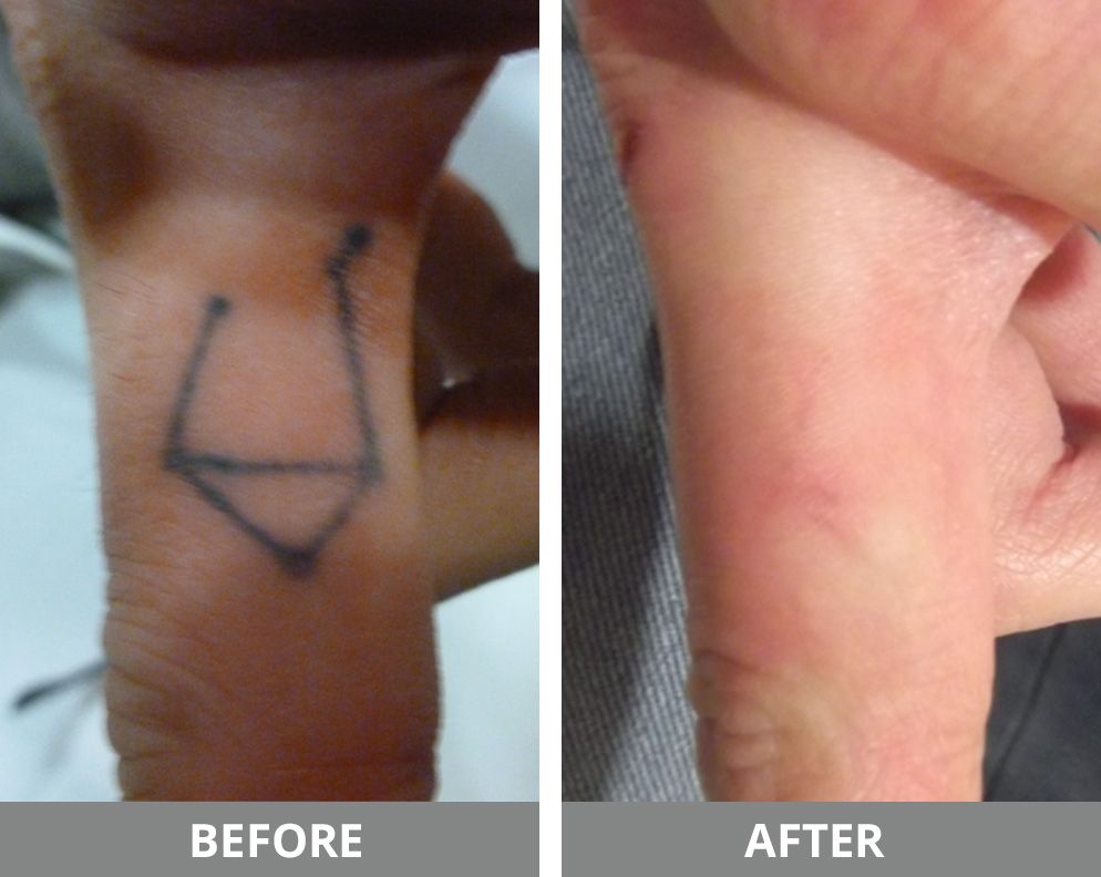 Laser Tattoo Removal Before & After