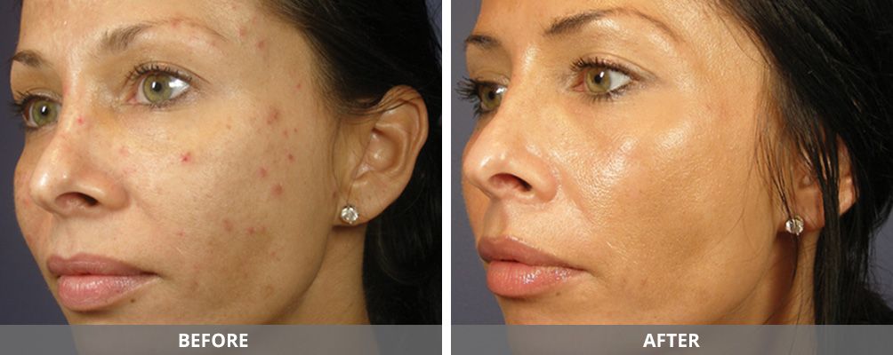 Chemical Peels Before & After