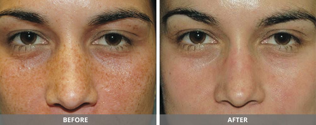 Chemical Peels Before & After