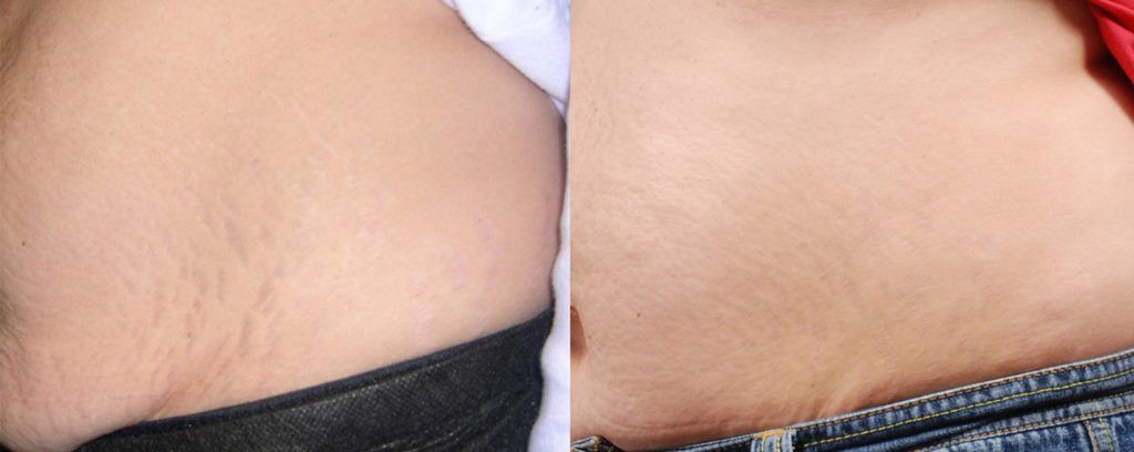 Fractional Laser Before & After