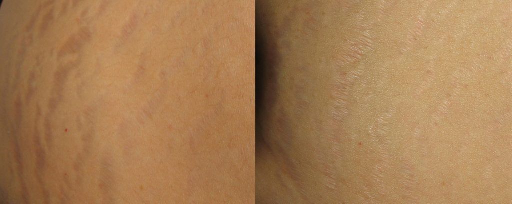 Fractional Laser Before & After