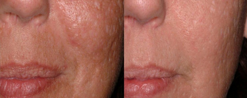 Fractional Laser Before & After